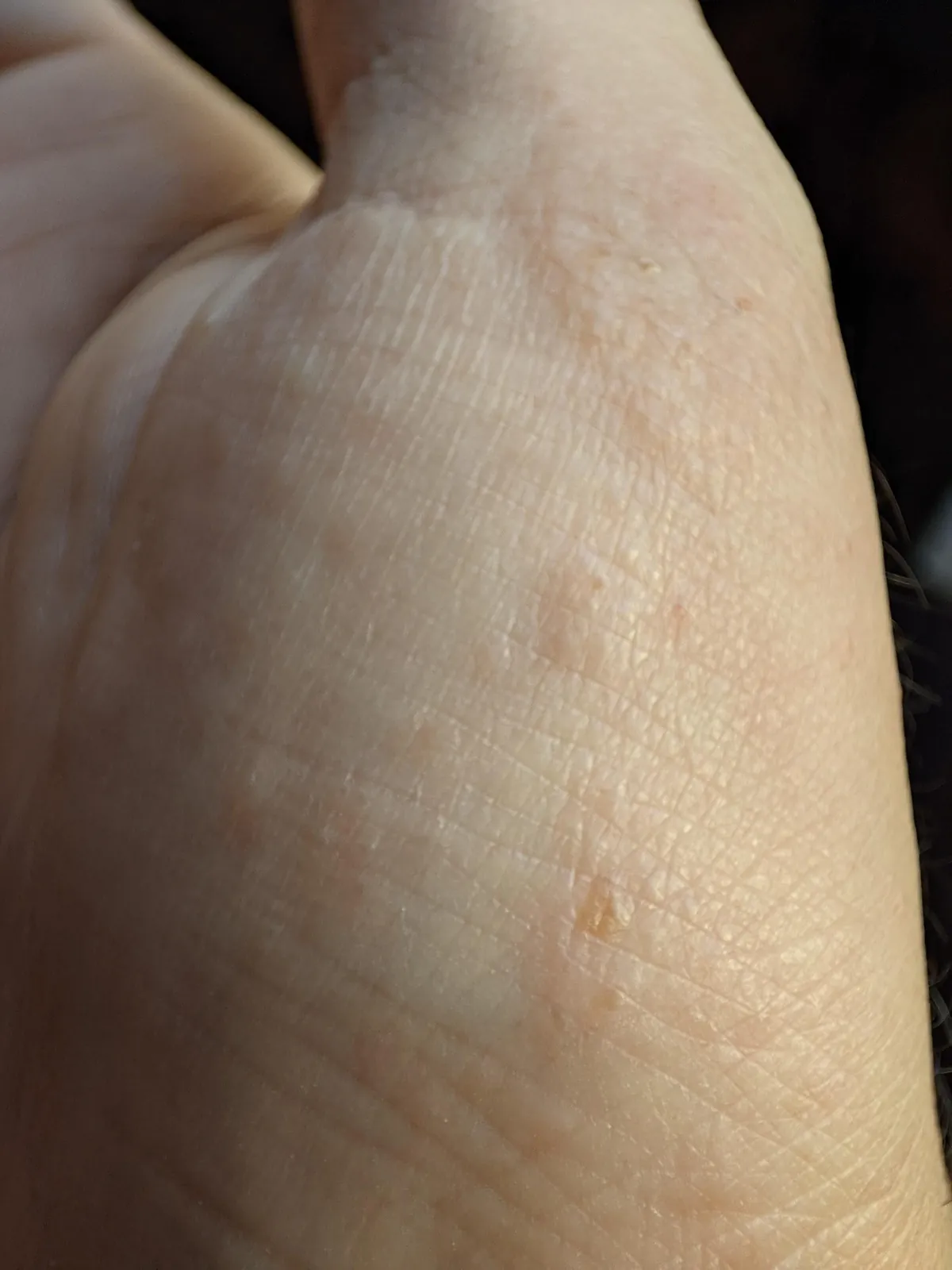 My dermatitis has evolved in just four days, and it only appears when I'm particularly stressed, always in the same spot. It's so itchy, it's a nightmare to work with.