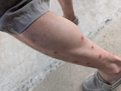 Walked on the beach for about thirty minutes that had sand fleas