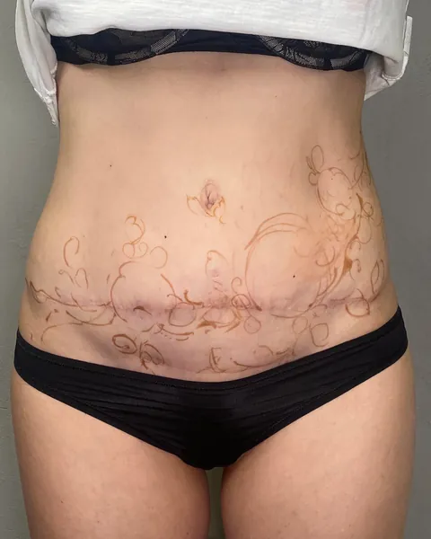 Scar tattoo cover ups (by me @karolinaszymanska_tattoo from Poland) 🌸