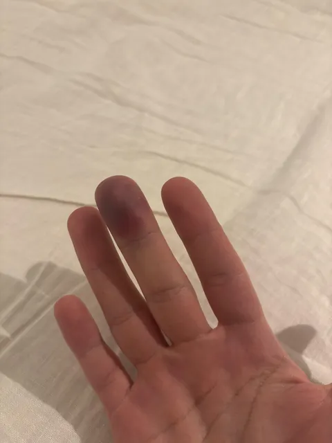 I dropped a 50kg door on my finger. Now it’s purple.