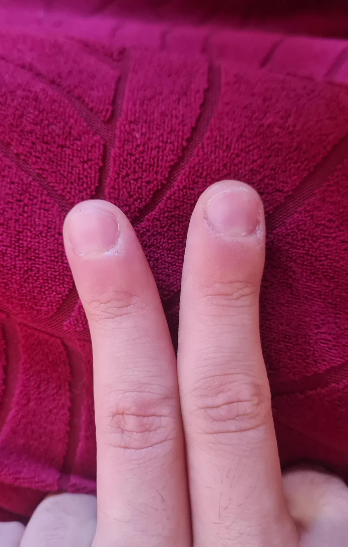 My fingers are not straight