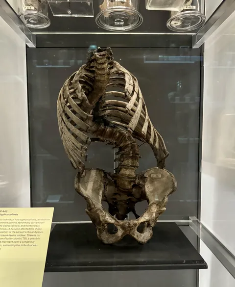 Skeleton of a person with severe scoliosis, Hunterian Museum London
