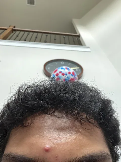 Today’s my birthday party and I have this pimple on my forehead