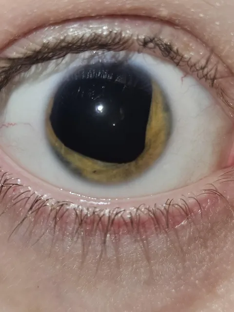 I have (almost) no eye colour