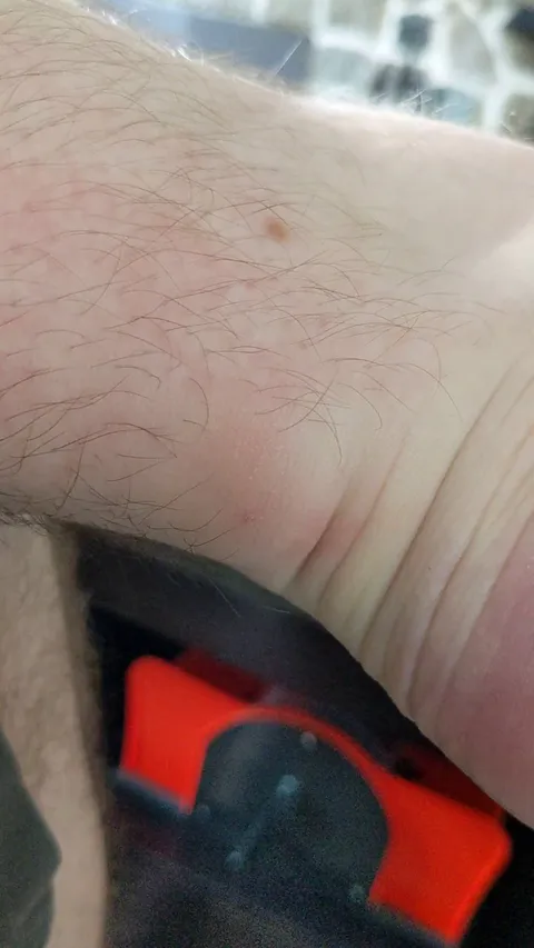 I can see my heartbeat in my mosquito bite