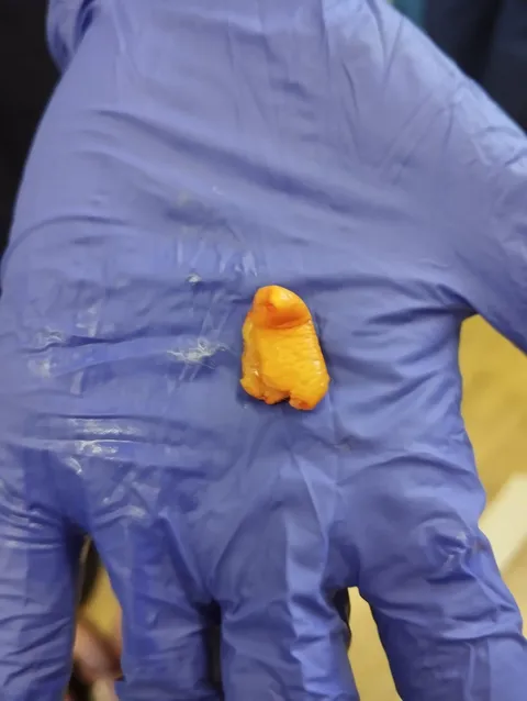 A piece of orange peel extracted from my daughter's nose