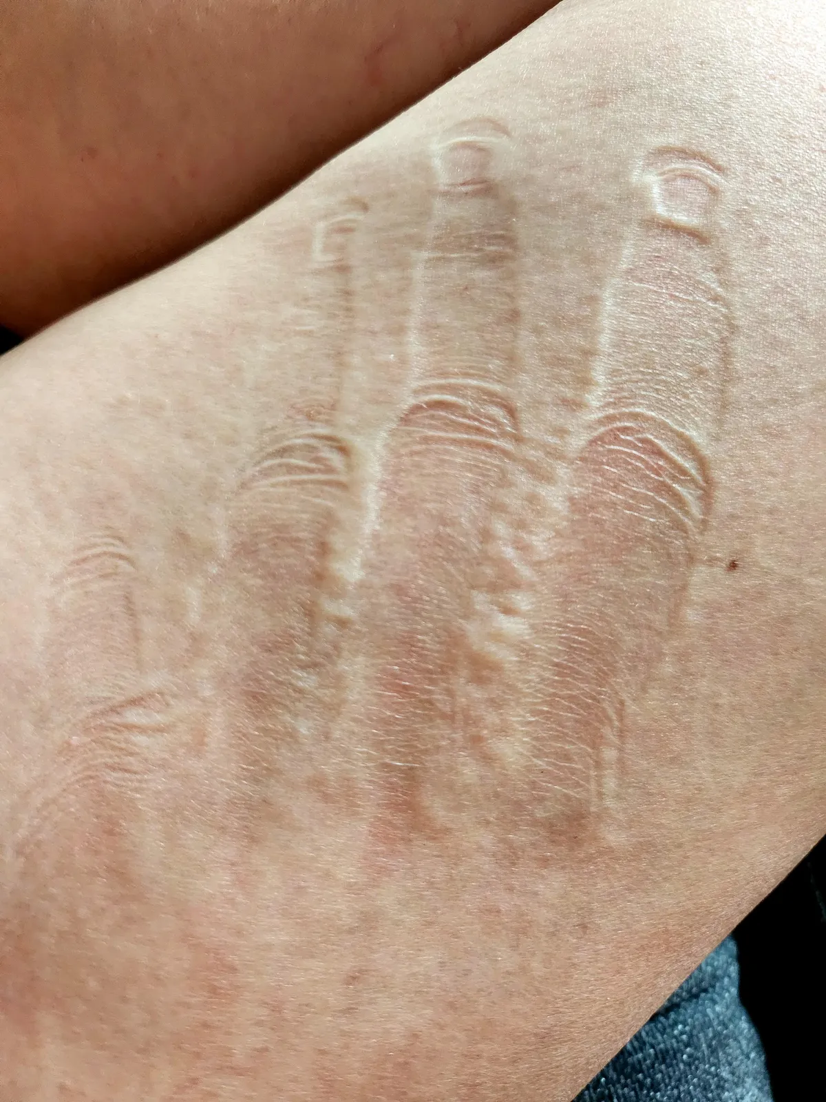 The very detailed imprint on my leg left by my hand while I was sleeping