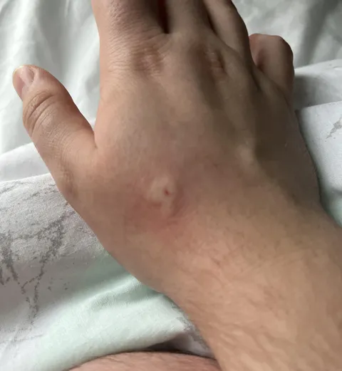 Woke up to a sharp pain in my hand only to find a bee had entered through the window and decided to sting my hand while I was sleeping 🙃