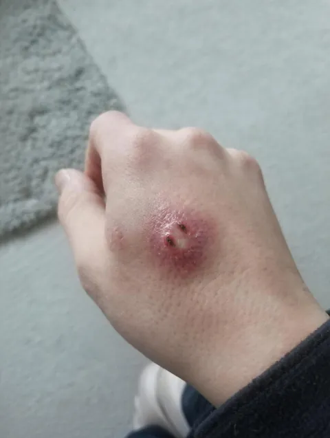 [OC] Got bit by a spider a few days ago