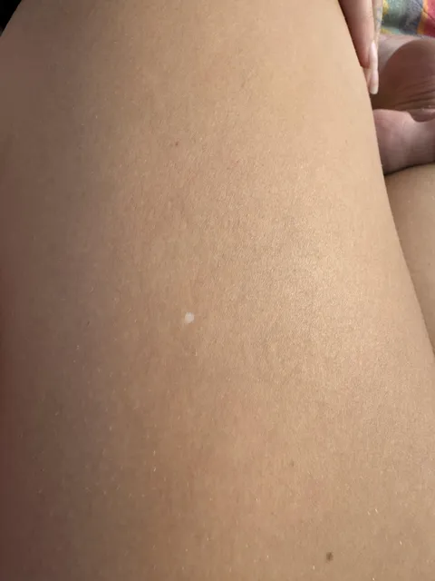 my gf has a white freckle
