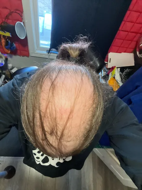 Am I doomed at 34 🤣 up vote if I should shave it all I need the confidence 🙏🏼