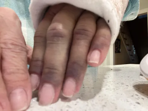 I broke my wrist and my hand became quite bruised.