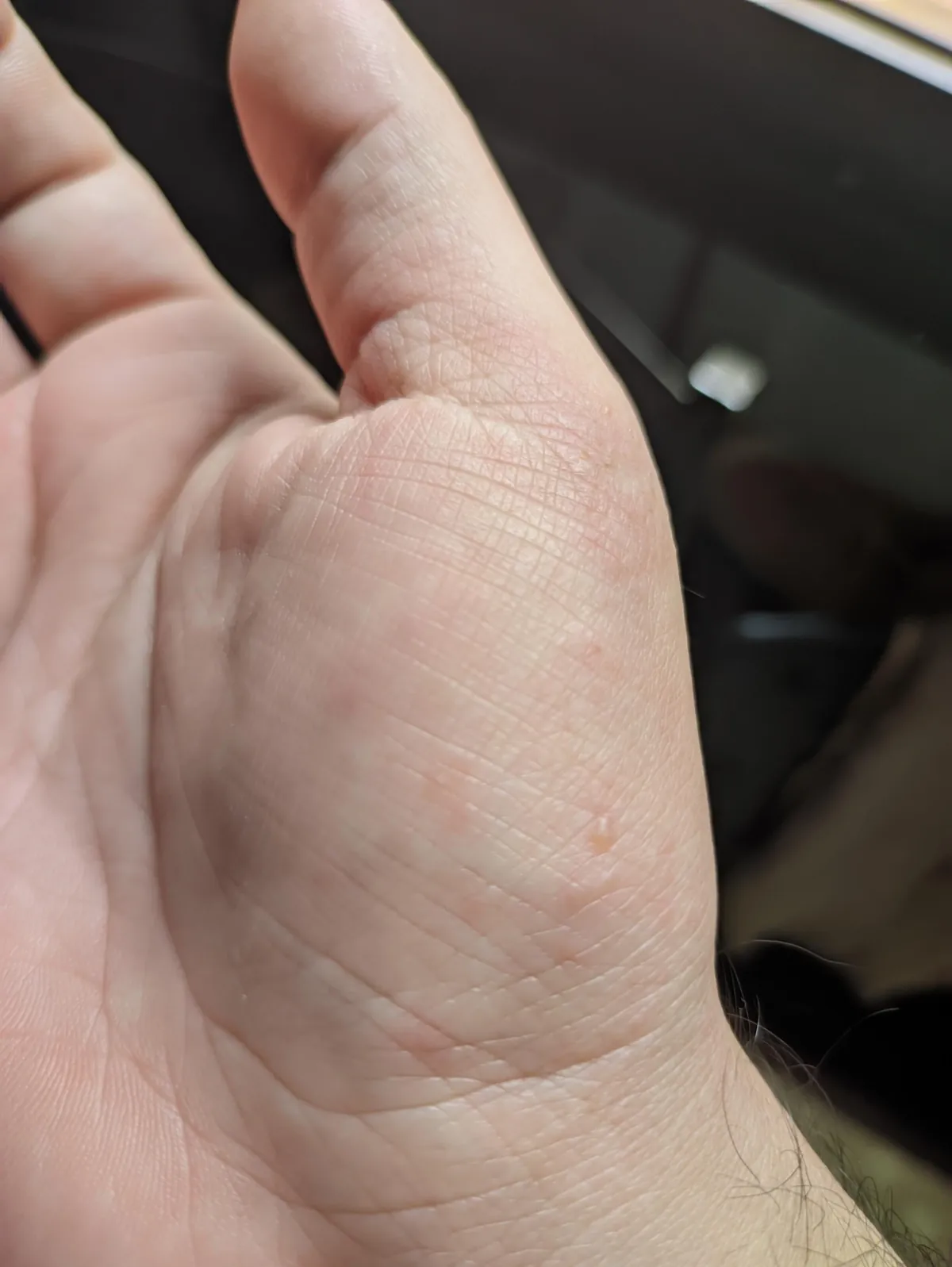 My dermatitis has evolved in just four days, and it only appears when I'm particularly stressed, always in the same spot. It's so itchy, it's a nightmare to work with.