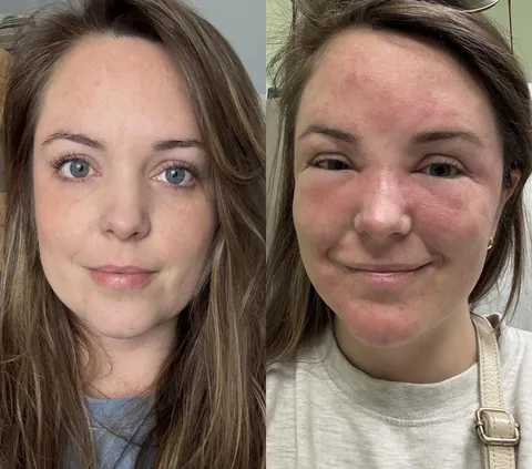 Friendly reminder to patch test, even with “clean” products. Rare Beauty Soft Pinch Lip Oil 💔