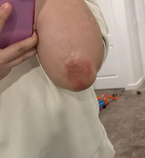 My body hates me after I ovulate. This is what it’s like living with Autoimmune Progesterone Dermatitis.