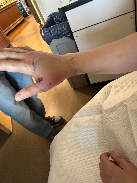 Just a reminder how serious cat bites can be!