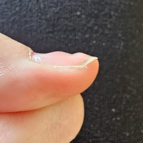 My thumbnail grows bumpy. The bumps then grows out and grows back in again