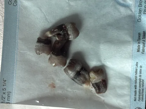 My black wisdom teeth