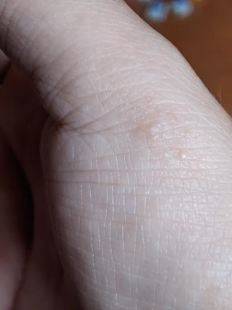 My dermatitis has evolved in just four days, and it only appears when I'm particularly stressed, always in the same spot. It's so itchy, it's a nightmare to work with.