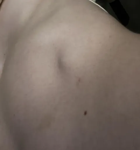 Another sleepless night as I was laying with my torso slightly to the side and had to sneeze, breaking a vertebral rib