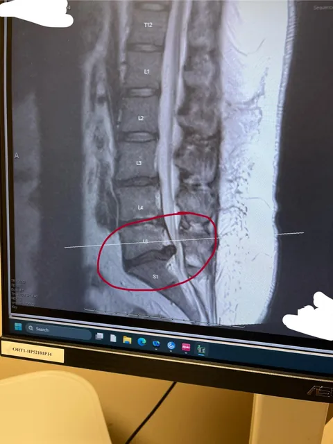 Been having severe back pain off and on for 5 years… kept getting told it was sciatica… guess what? Better! Herniated disk