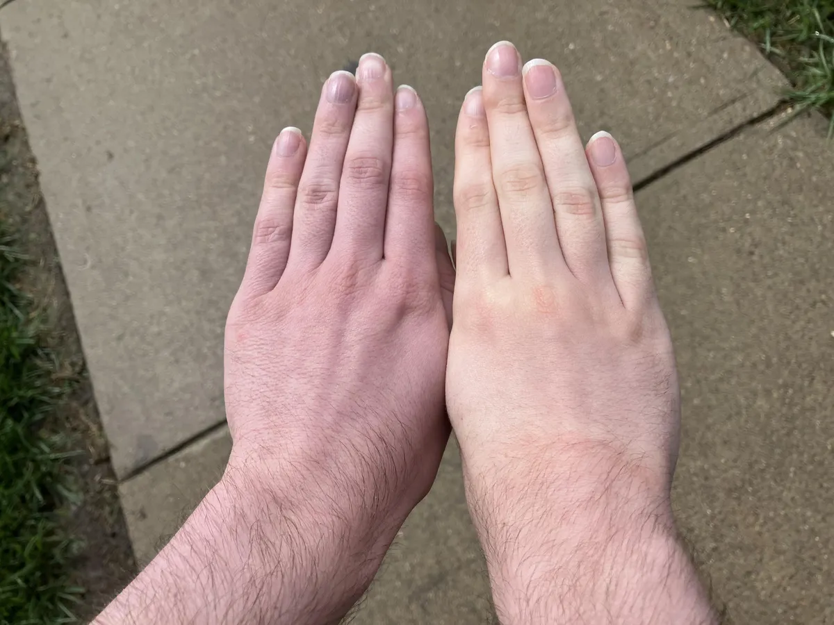The color difference in my hands after donating blood