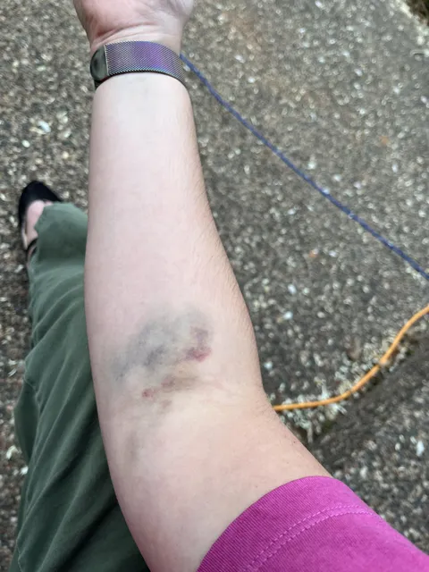 I always tell the phlebotomist that I bruise easily so they can use a smaller needle and allow me to apply pressure immediately. She responded with “you’ll be fine”. It was not fine.