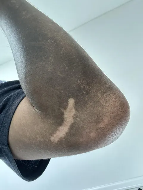 The scar on my arm doesn’t get dirty