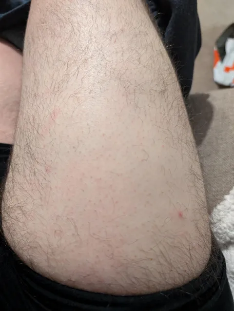 I have a patch of smooth skin on an otherwise hairy leg from where I carry my phone/wallet in my pocket.