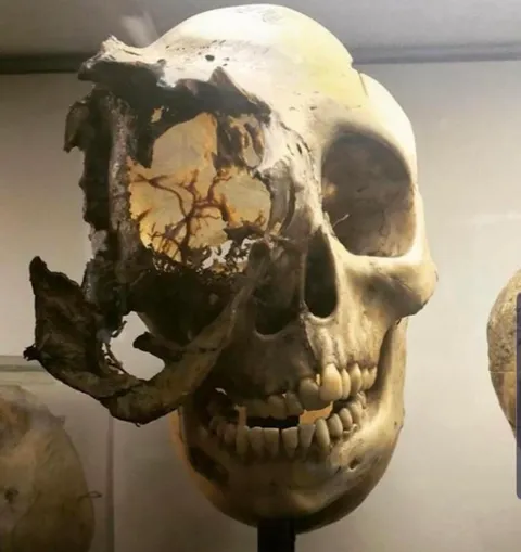 Skeletal Cancer aftermath