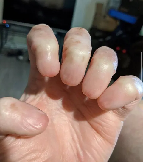 Anonychia is the partial or total absence of one or more nails on the fingers or toes.