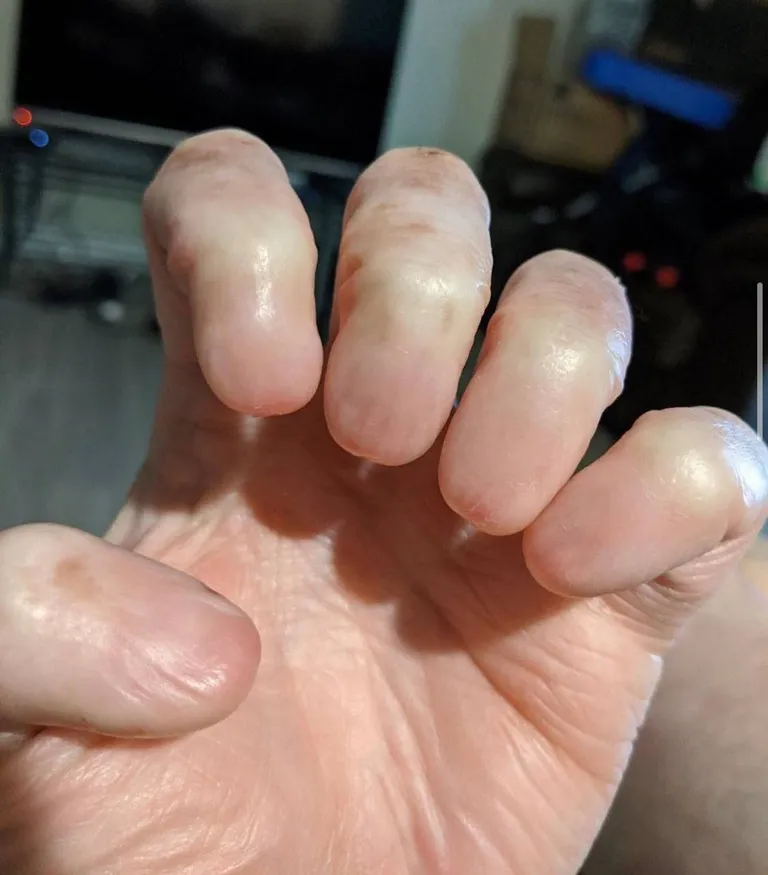 Anonychia is the partial or total absence of one or more nails on the fingers or toes.