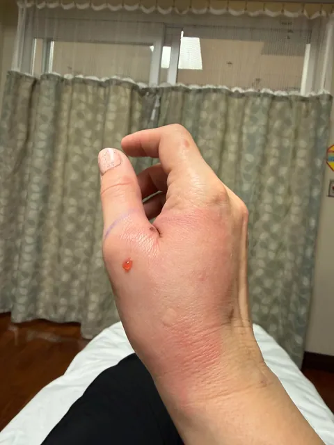 Just a reminder how serious cat bites can be!