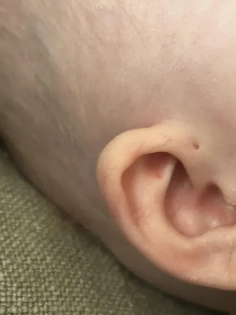 My daughter was born with two tiny holes next to both her ears