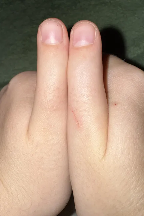 I have a birth defect that makes me unable to bend my thumbs.