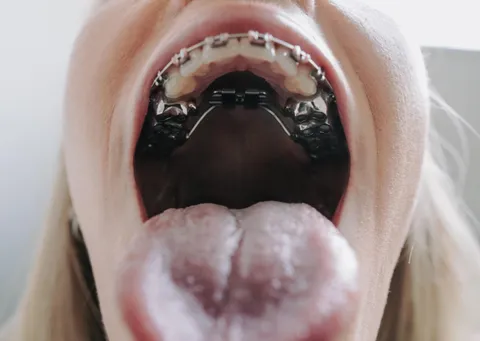 My ortho when I show him my braces progress: 🥵🥵🥵💦