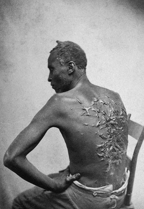 Escaped slave Gordon “Whipped Peter” shows his scars from back in Louisiana, 1863.