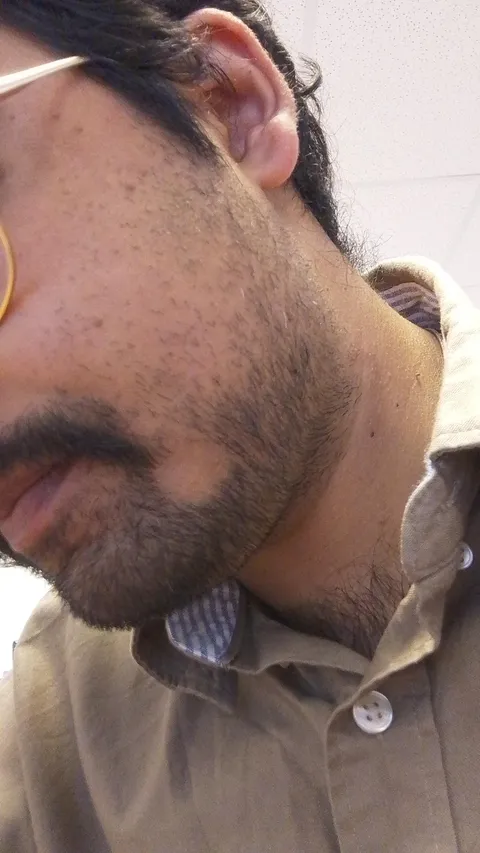 This circular gap in my beard where the hair won't grow back.