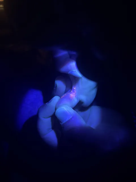 found out athletes foot glows under UV light