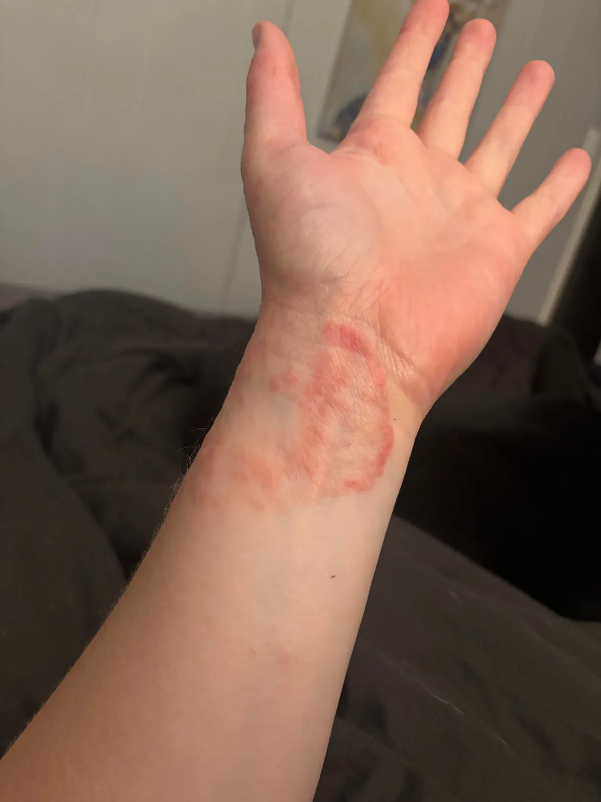 My inflamed hand. Has been this way since the spring