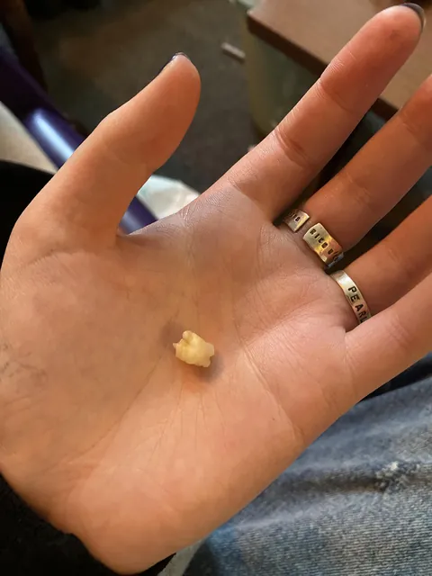 A tooth that was part of a tumour in my ovary that I recently had removed