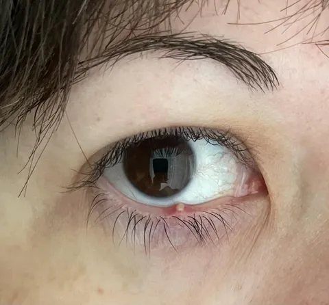 Of all the places this pimple decided to spawn