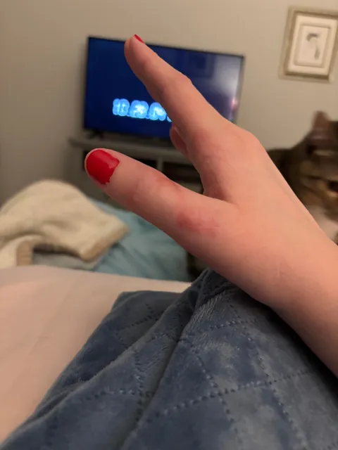 When you can’t use your thumb for 3 months, the creases go away!