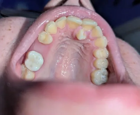 tooth grew at the roof of my mouth finally got removed