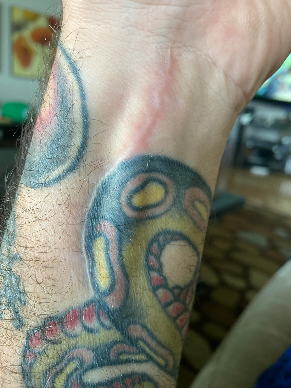 Wrist surgery. My surgeon incised around my tattoo. He could have not cared and cut right through it. Pretty bro move if you ask me.