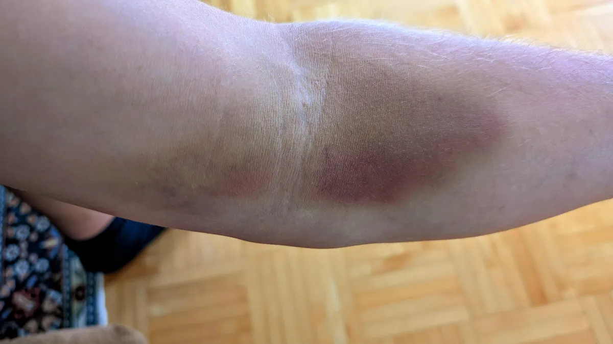 Doctor punctured my vein while taking blood..