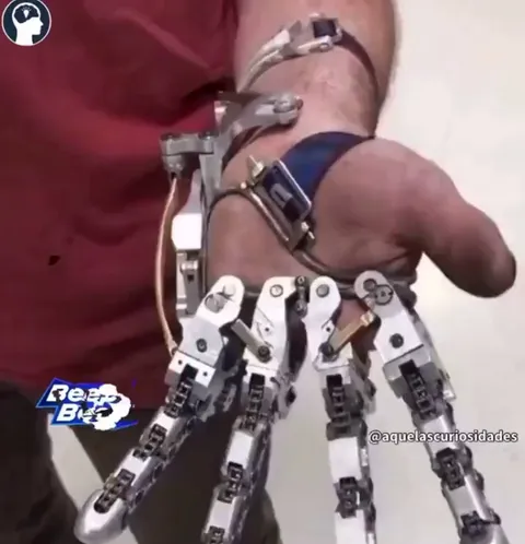 Engineer Ian Davis built his own mechanical prosthetic when his medical insurance did not cover him, it functions without batteries or electricity