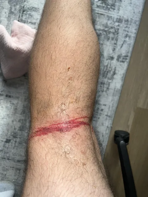 Leash wrapped around my knee while walking a super hyper dog…