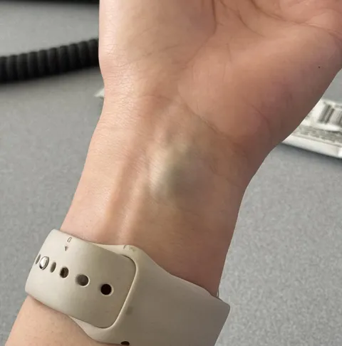 Budging wrist vein I’ve had since birth
