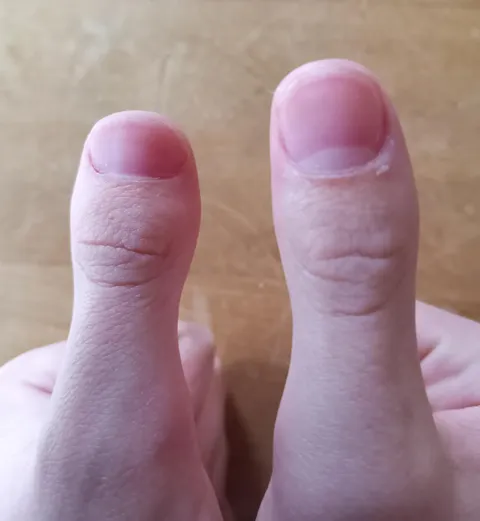 One of my thumbs is larger than the other